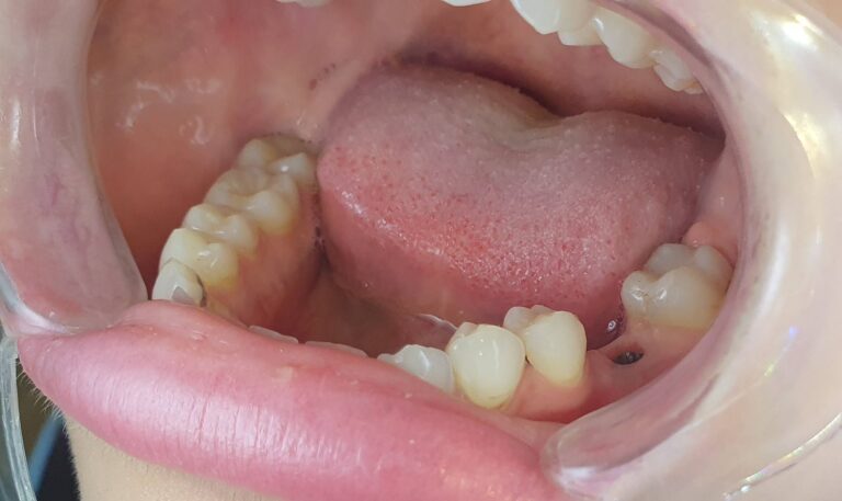 Metamorfoza 2 - przed