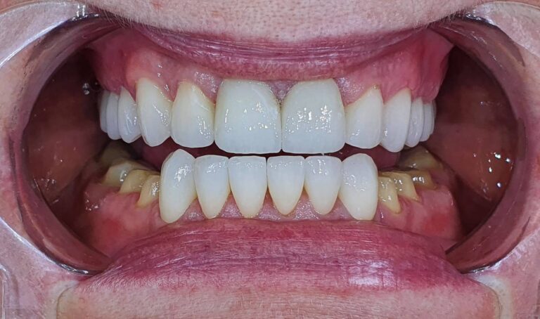 Metamorfoza 3 - przed